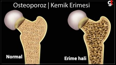 Osteoporozdan Korunmak İçin Ne Yapılmalı?