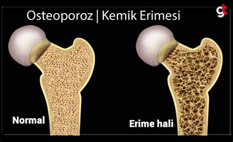 Osteoporozdan Korunmak İçin Ne Yapılmalı?